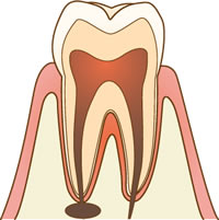 根管治療とは？