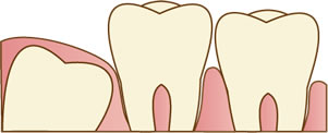 親知らずは抜く必要があるの？