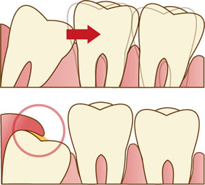 親知らずを抜く必要があるのは？